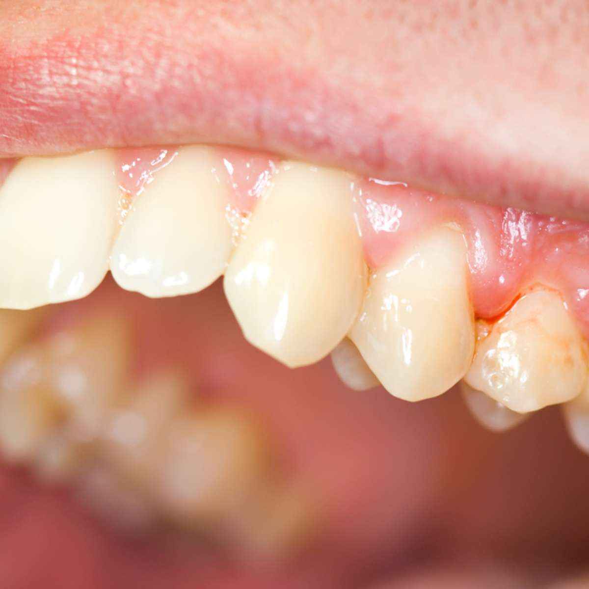  Mít sen o krvácejícím zubu: Co to znamená?