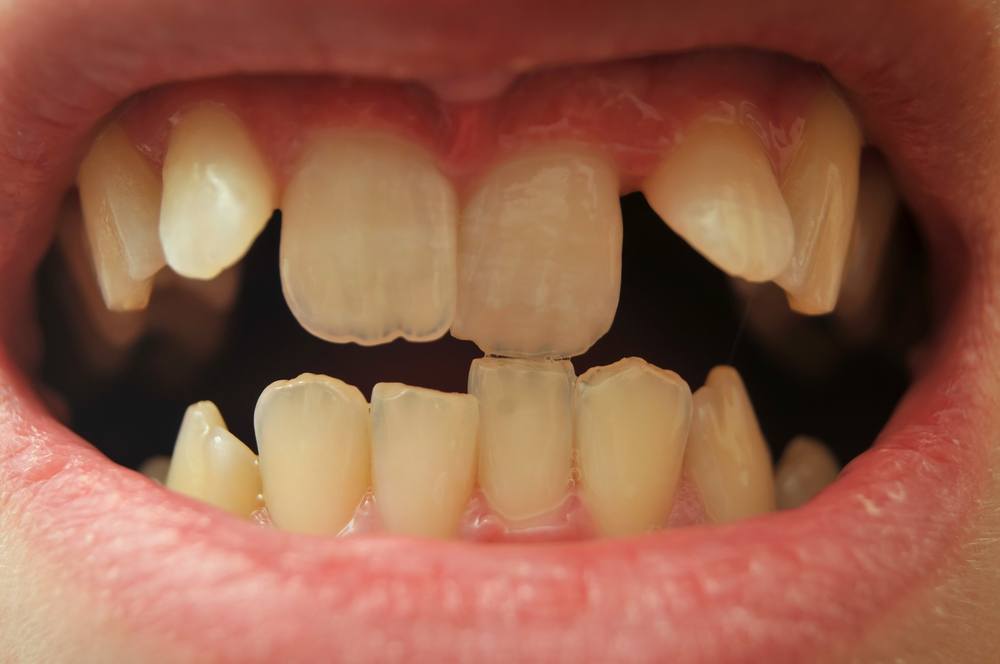  At drømme om en skæv tand: Hvad betyder det?